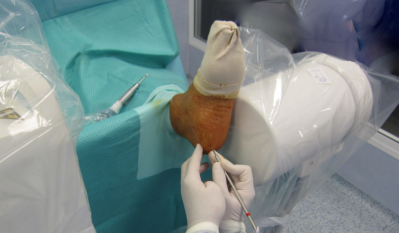 Espolón Calcáneo, Fascitis Plantar, Pie Plano Ibiza