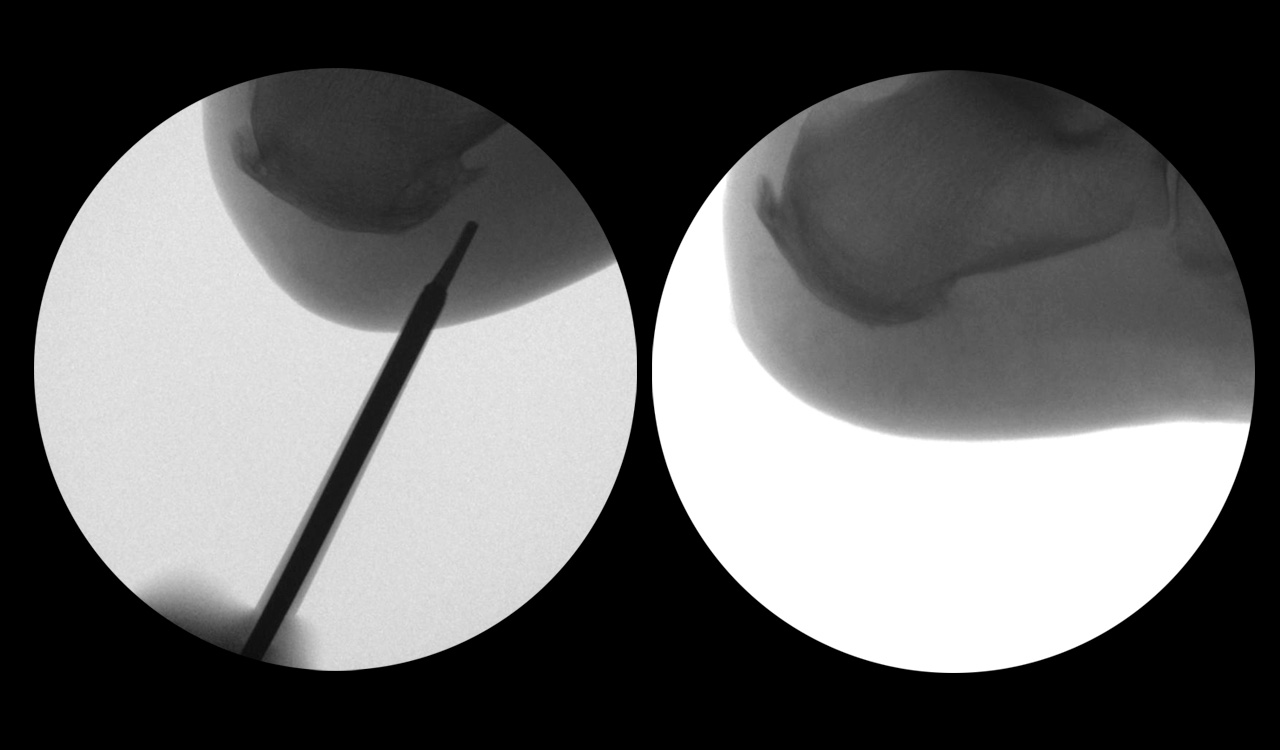 Espolón Calcáneo, Fascitis Plantar, Pie Plano Ibiza