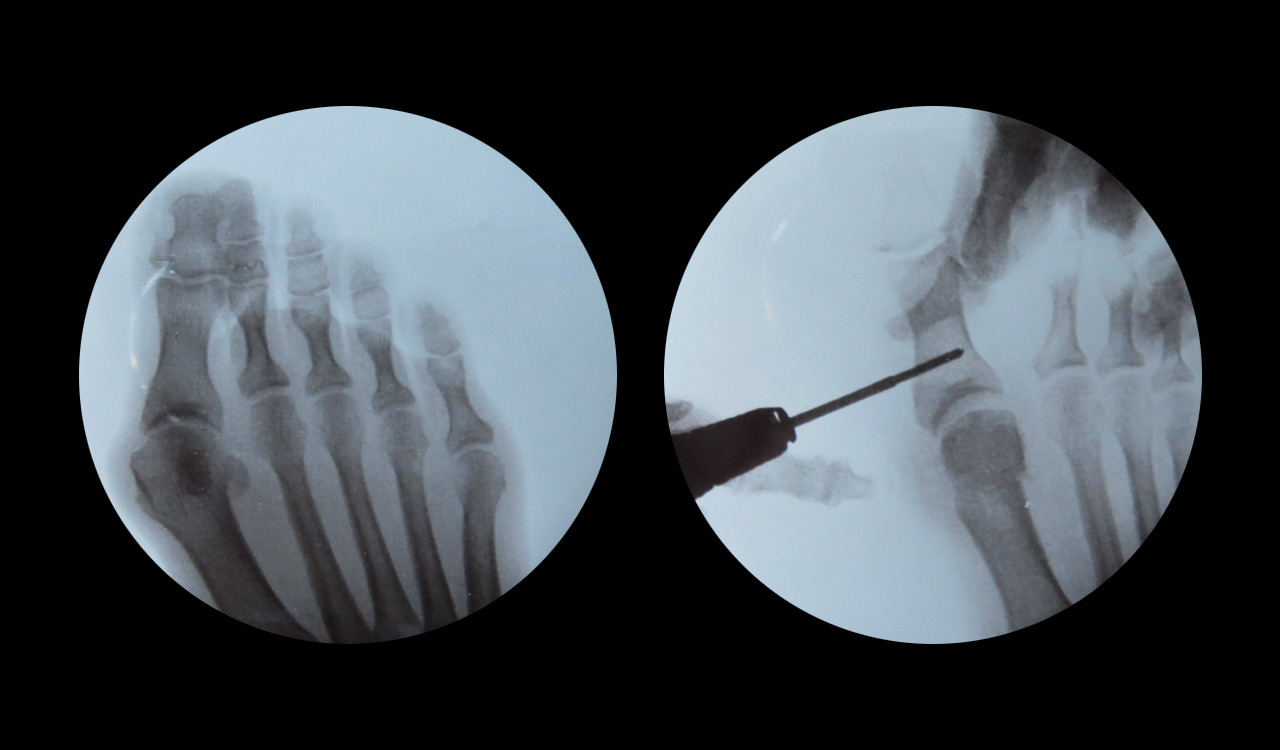 Tratamiento Hallux Valgus, Metatarsalgia, Juanete de sastre en Ibiza