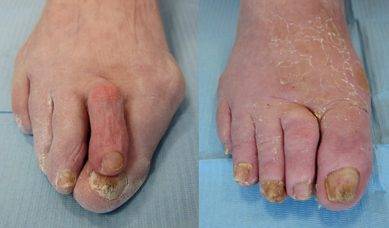 Tratamiento Hallux Valgus, Metatarsalgia, Juanete de sastre en Ibiza